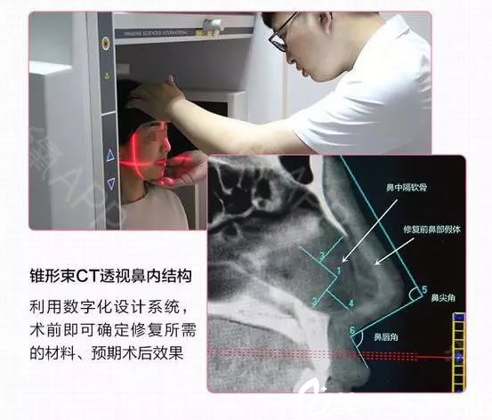 經(jīng)過數(shù)字化系統(tǒng)檢測鼻部填充的是奧美定 經(jīng)過數(shù)字化系統(tǒng)檢測鼻部填充的是奧美定