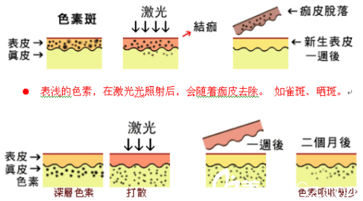 濟(jì)源<!--<i data=20240703-sp></i>-->萍激光祛斑的過程 濟(jì)源<!--<i data=20240703-sp></i>-->萍激光祛斑的過程