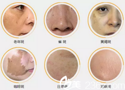 濟(jì)源<!--<i data=20240703-sp></i>-->萍激光祛斑的種類 濟(jì)源<!--<i data=20240703-sp></i>-->萍激光祛斑的種類