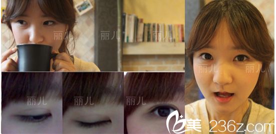 下頜角手術(shù)一個(gè)月后效果