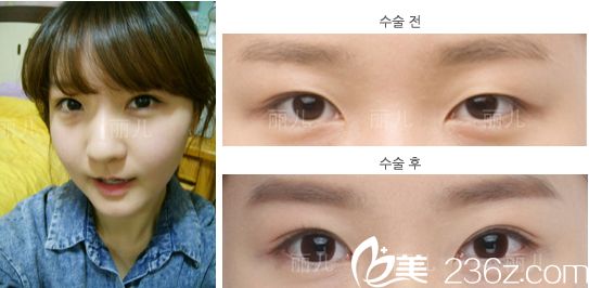 等了一個月終于預(yù)約上了金壽信，隨后在韓國麗兒整形醫(yī)院做了雙眼皮+顴骨內(nèi)推+下頜角手術(shù)后我重新拾起了自信