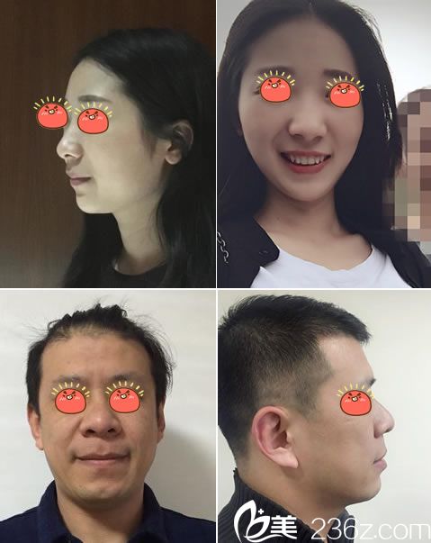 杭州維多利亞柳兆峰做激光除皺案例