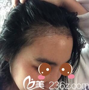 種植發(fā)際線半個月