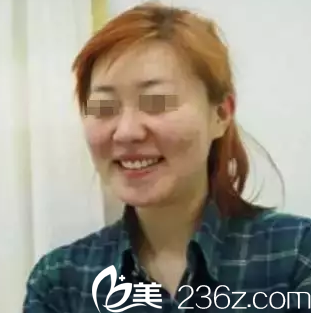 我在<!--<i data=20240703-sp></i>-->整形醫(yī)院做面部線雕提升前的照片 我在<!--<i data=20240703-sp></i>-->整形醫(yī)院做面部線雕提升前的照片