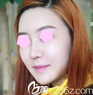 來看看我在整形做6D面部線雕提升一周后的照片，對比效果明顯嗎？