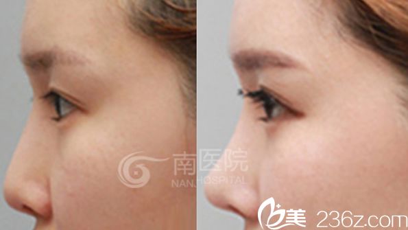 南京華美整形醫(yī)院隆鼻真人案例圖