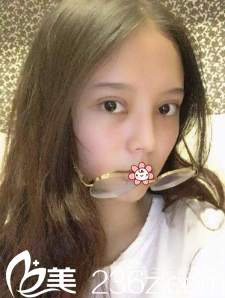 王志軍全切雙眼皮術(shù)后4天