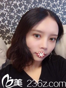 重慶聯(lián)合麗格整形全切雙眼皮術(shù)后半個(gè)月