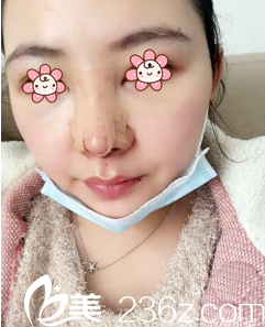 重慶曹陽麗格鼻綜合術后三天 重慶曹陽麗格鼻綜合術后三天