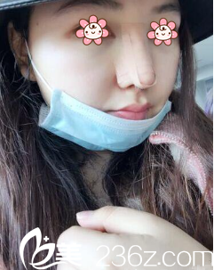 曹陽院長給我做完術后五天 曹陽院長給我做完術后五天