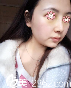 曹陽鼻綜合+假體隆鼻術后8天 曹陽鼻綜合+假體隆鼻術后8天