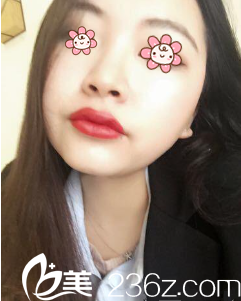 重慶曹陽麗格鼻綜合+假體隆鼻術后19天效果 重慶曹陽麗格鼻綜合+假體隆鼻術后19天效果