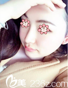 我叫王暻，是去年11月在重慶曹陽麗格院長那兒做的鼻綜合+假體隆鼻手術(shù)。