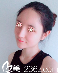 新疆伊麗莎白整形自體脂肪填充額頭墊下巴術(shù)后18天 新疆伊麗莎白整形自體脂肪填充額頭墊下巴術(shù)后18天