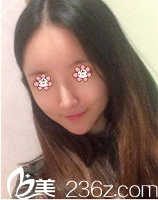 在新疆伊麗莎白做完鼻綜合+自體脂肪豐額頭+墊下巴把爹媽遺傳給我的缺點都整好了。