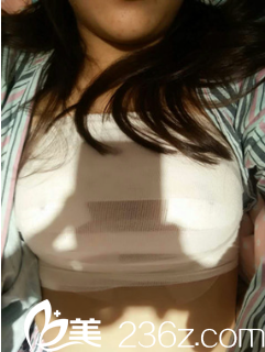 許黎自體脂肪豐胸術(shù)后一周 許黎自體脂肪豐胸術(shù)后一周
