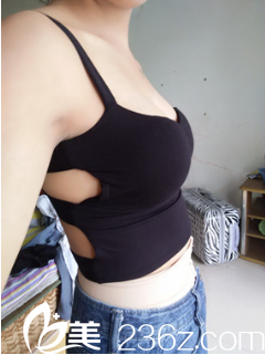 讓新疆黎美整形許黎給做完自體脂肪隆胸后我才覺得以前吃豐胸藥真傻！