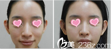 韓國Pureart整形外科醫(yī)院面部脂肪填充案例 韓國Pureart整形外科醫(yī)院面部脂肪填充案例