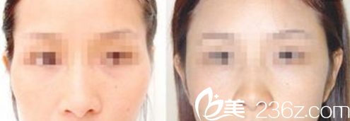 韓國Pureart整形外科自體脂肪豐太陽穴案例 韓國Pureart整形外科自體脂肪豐太陽穴案例