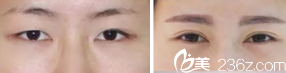 韓國Pureart整形外科雙眼皮案例 韓國Pureart整形外科雙眼皮案例