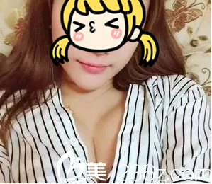 任萬洙脂肪豐胸案例第47天樣子