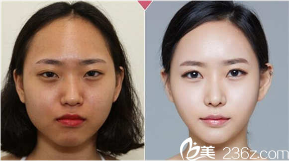 袁耀東醫(yī)生塑美案例 袁耀東醫(yī)生塑美案例