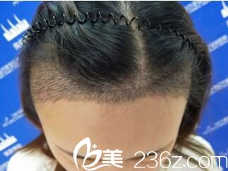 發(fā)際線種植一周