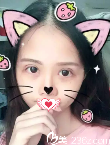 術(shù)后7天雙眼皮拆線后的樣子 術(shù)后7天雙眼皮拆線后的樣子