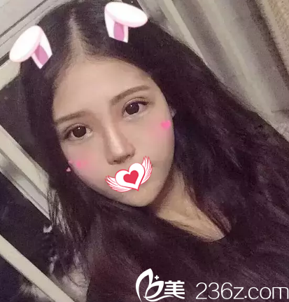 雙眼皮25天完全消腫 雙眼皮25天完全消腫