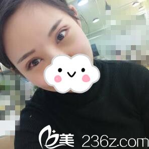 切開雙眼皮術(shù)后天 切開雙眼皮術(shù)后天