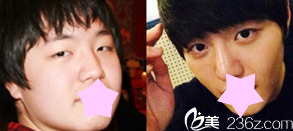 本沐整形醫(yī)院眼睛和鼻子術(shù)前后效果