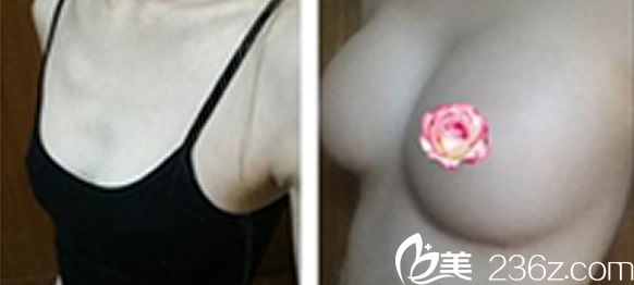 韓國(guó)本沐整形醫(yī)院自體豐胸前后效果 韓國(guó)本沐整形醫(yī)院自體豐胸前后效果