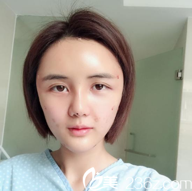 找深圳美萊整形醫(yī)院梁曉健做完自體脂肪彈窗第二天效果圖 找深圳美萊整形醫(yī)院梁曉健做完自體脂肪彈窗第二天效果圖