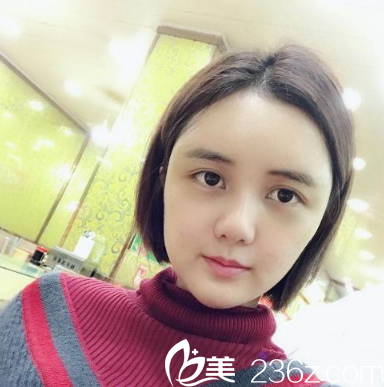 深圳美萊梁曉健做的自體脂肪填充術(shù)后十天圖片 深圳美萊梁曉健做的自體脂肪填充術(shù)后十天圖片