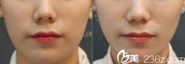 本沐整形埋線提升前后效果圖 本沐整形埋線提升前后效果圖