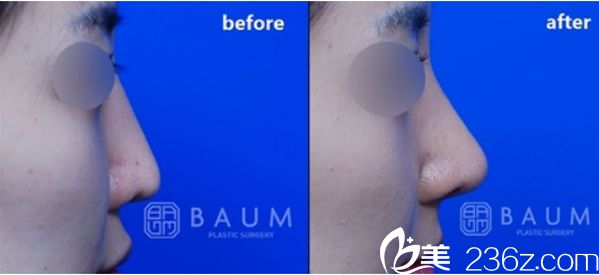 韓國柏恩整形鼻整形效果對比圖