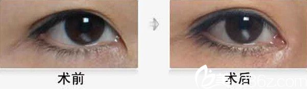 韓國優(yōu)容整形外科開眼角案例
