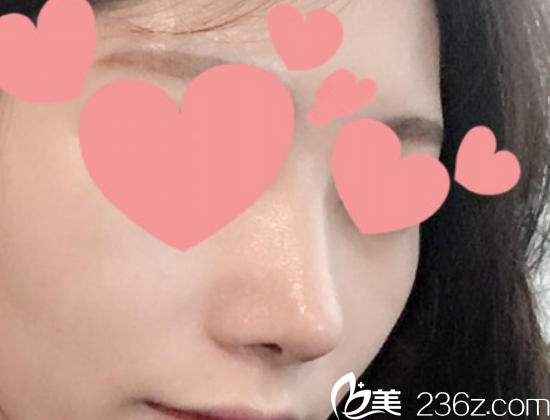 我在韓國柏恩整形外科做了鷹鉤鼻綜合整形，真心覺得樸光珉做鼻子的技術超贊