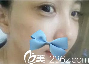 濮陽源美溫賞做的面部脂肪填充