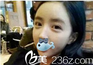 濮陽源美溫賞做的面部脂肪填充術(shù)后2周