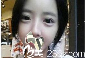 濮陽源美溫賞做的面部脂肪填充術(shù)后1個月