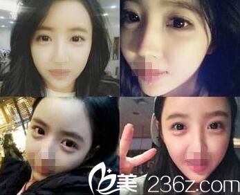 在濮陽(yáng)源美溫賞做了面部脂肪填充 別人根本看不出我的整形痕跡