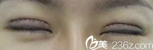 雙眼皮修復(fù)天