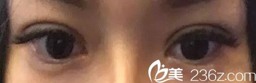 割雙眼皮20天后的效果