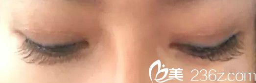三個月后雙眼皮的二次修復(fù)圖
