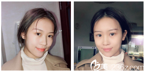 廣州軍美產(chǎn)慎之醫(yī)生雙眼皮案例術(shù)后七天拆線圖片 廣州軍美產(chǎn)慎之醫(yī)生雙眼皮案例術(shù)后七天拆線圖片