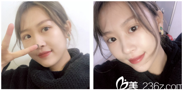 廣州軍美產(chǎn)慎之雙眼皮案例術(shù)后十天自拍 廣州軍美產(chǎn)慎之雙眼皮案例術(shù)后十天自拍