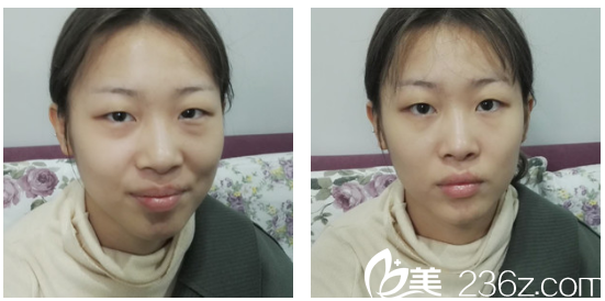 來(lái)廣州軍美做雙眼皮前的照片 來(lái)廣州軍美做雙眼皮前的照片