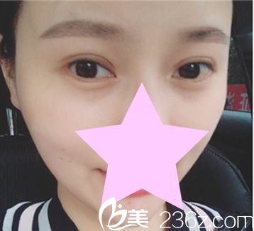 外切眼角手術(shù)后恢復(fù)效果