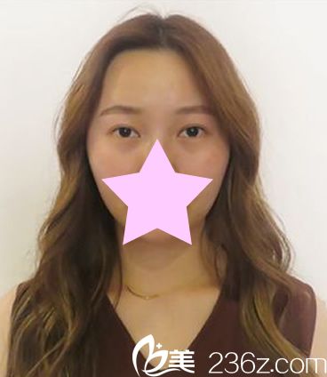 外切眼角手術(shù)前照片